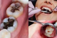 Dental Pain & Cavity: ৫ ছোট্ট কাজে পোকা-কালো গর্ত মুক্ত আপনার দাঁত! মুঠো মুঠো টাকা ছাড়াই সারবে দাঁত-মাড়ির রোগ