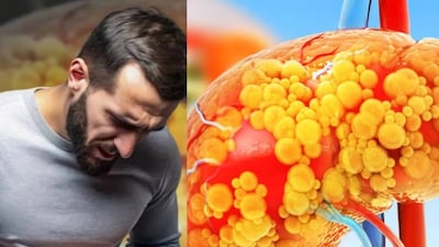 শরীরের ৫০০ টিরও বেশি কাজে লিভার গুরুত্বপূর্ণ ভূমিকা পালন করে। এই অঙ্গের সবচেয়ে গুরুত্বপূর্ণ বৈশিষ্ট্য হল এটির ডিটক্সিফিকেশনের প্রয়োজন হয় না। এটি একটি স্ব-পরিষ্কারকারী বা সেল্ফ ডিটক্সিং অঙ্গ। তবে, খারাপ খাদ্যাভ্যাসের কারণে, প্রায়ই লিভারে চর্বি জমা হয়, যা একটি উদ্বেগজনক পরিস্থিতি। একে ফ্যাটি লিভার বলা হয়। যদি এটি সময়মতো নিয়ন্ত্রণ না করা হয়, তবে এটি মারাত্মকও হতে পারে।