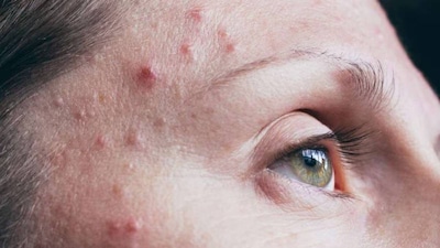 মুখে ঘন ঘন ব্রণ দেখা দেওয়া আজকাল একটি সাধারণ সমস্যা হয়ে দাঁড়িয়েছে। খারাপ খাদ্যাভ্যাস, মানসিক চাপ, হরমোনের পরিবর্তন এবং ত্বকের যত্নের প্রতি অবহেলা প্রায়ই এর কারণ হিসেবে উল্লেখ করা হয়, তবে কখনও কখনও পুষ্টির ঘাটতিও এর জন্য দায়ী। কিছু প্রয়োজনীয় ভিটামিনের ঘাটতি সরাসরি ত্বকের স্বাস্থ্যের উপর প্রভাব ফেলে, যার ফলে ব্রণ, এবং বিভিন্ন রকম দাগ দেখা দেয়। যদি ব্রণ দীর্ঘ সময় ধরে থাকে, তাহলে এটি একটি লক্ষণ হতে পারে যে শরীর এই প্রয়োজনীয় ভিটামিনগুলি পর্যাপ্ত পরিমাণে পাচ্ছে না।