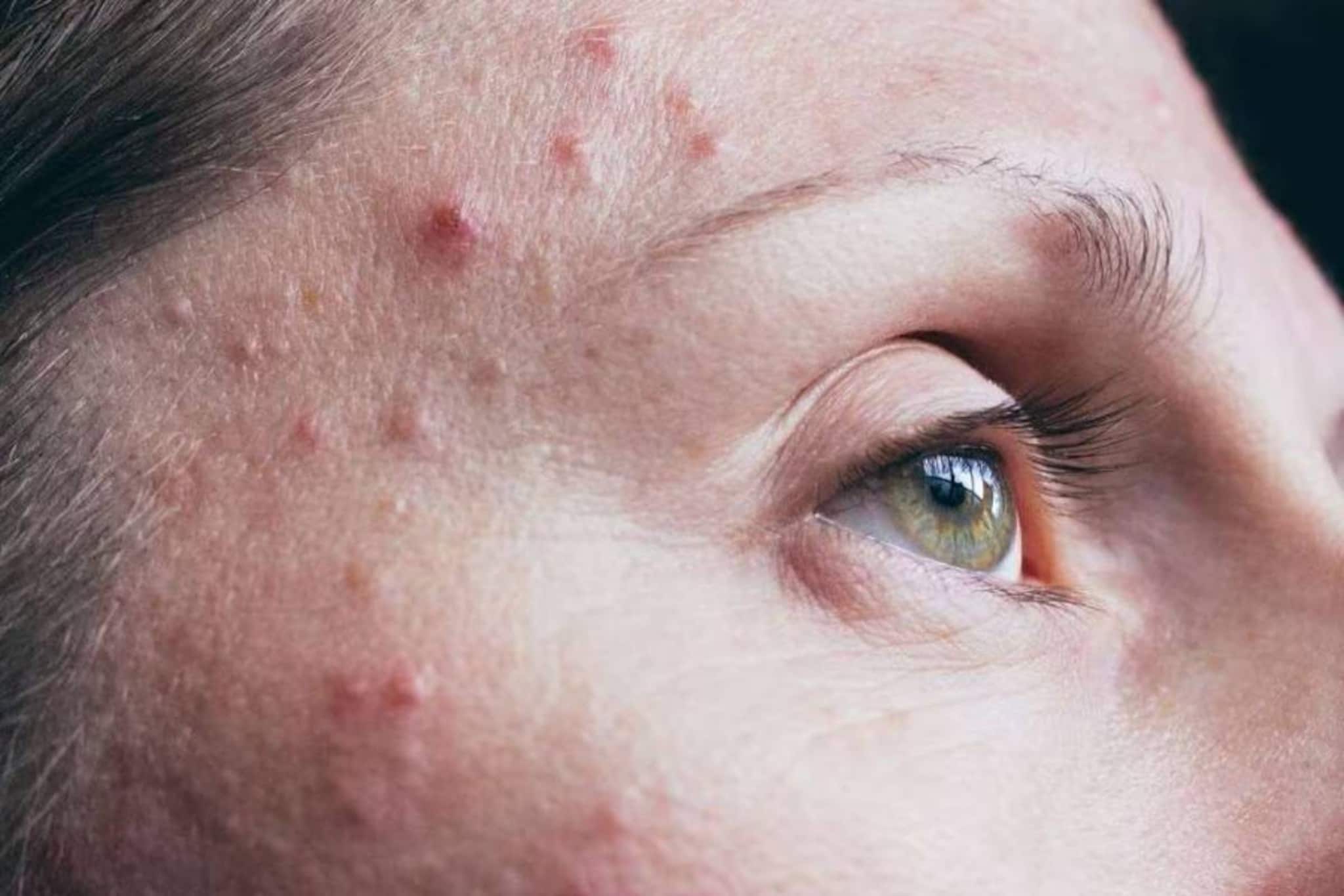 কোন ভিটামিনের অভাবে মুখ ভরে ব্রণ হয়? দাগহীন ফুটফুটে মুখ পেতে কী কী খাবেন? জানুন