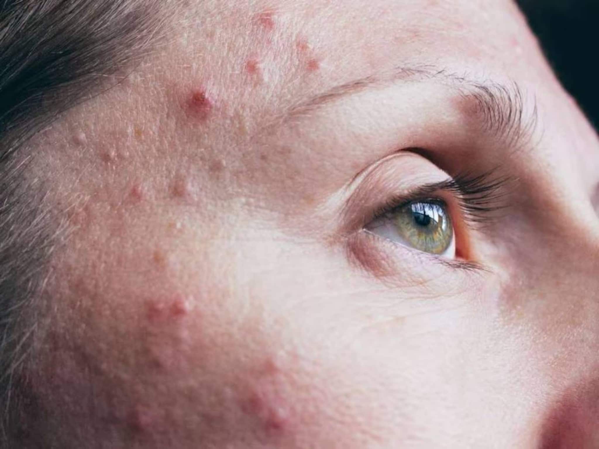 কোন ভিটামিনের অভাবে মুখ ভরে ব্রণ হয়? দাগহীন ফুটফুটে মুখ পেতে কী কী খাবেন? জানুন