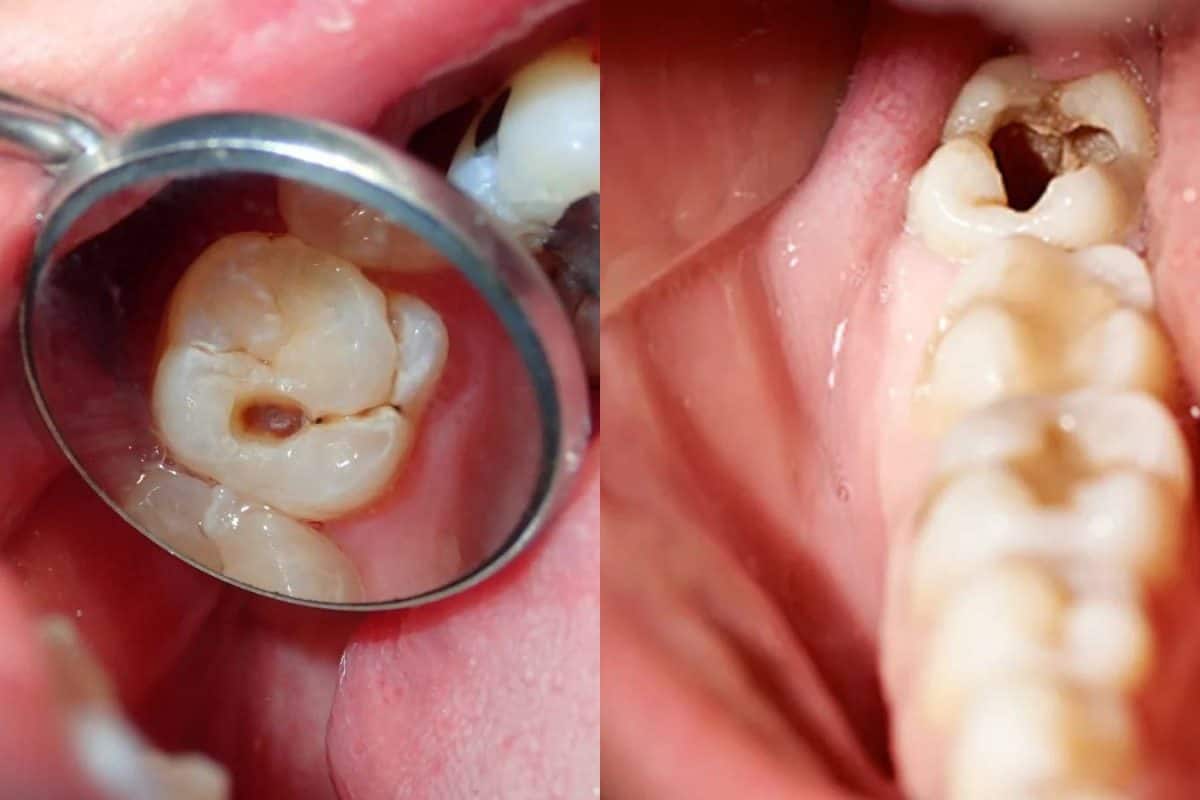 ৫ উপায়ের পঞ্চবাণ! দাঁতে হবে না পোকা! দেখা দেবে না কালো গর্ত! পগারপার মাড়ির রোগ