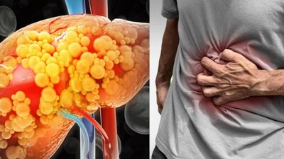 Even If The Blood Tests Look Normal, There Is A Chance The Liver Isn’t, Expert Explains