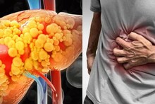 Liver Problems: ব্লাড টেস্ট স্বাভাবিক বলে নিশ্চিন্ত? এই ভুল করবেন না! লিভারের অসুখ অনেকসময় রক্ত পরীক্ষায় ধরা পড়ে না, কোন উপসর্গ ভয়ের? জানাচ্ছেন চিকিৎসক