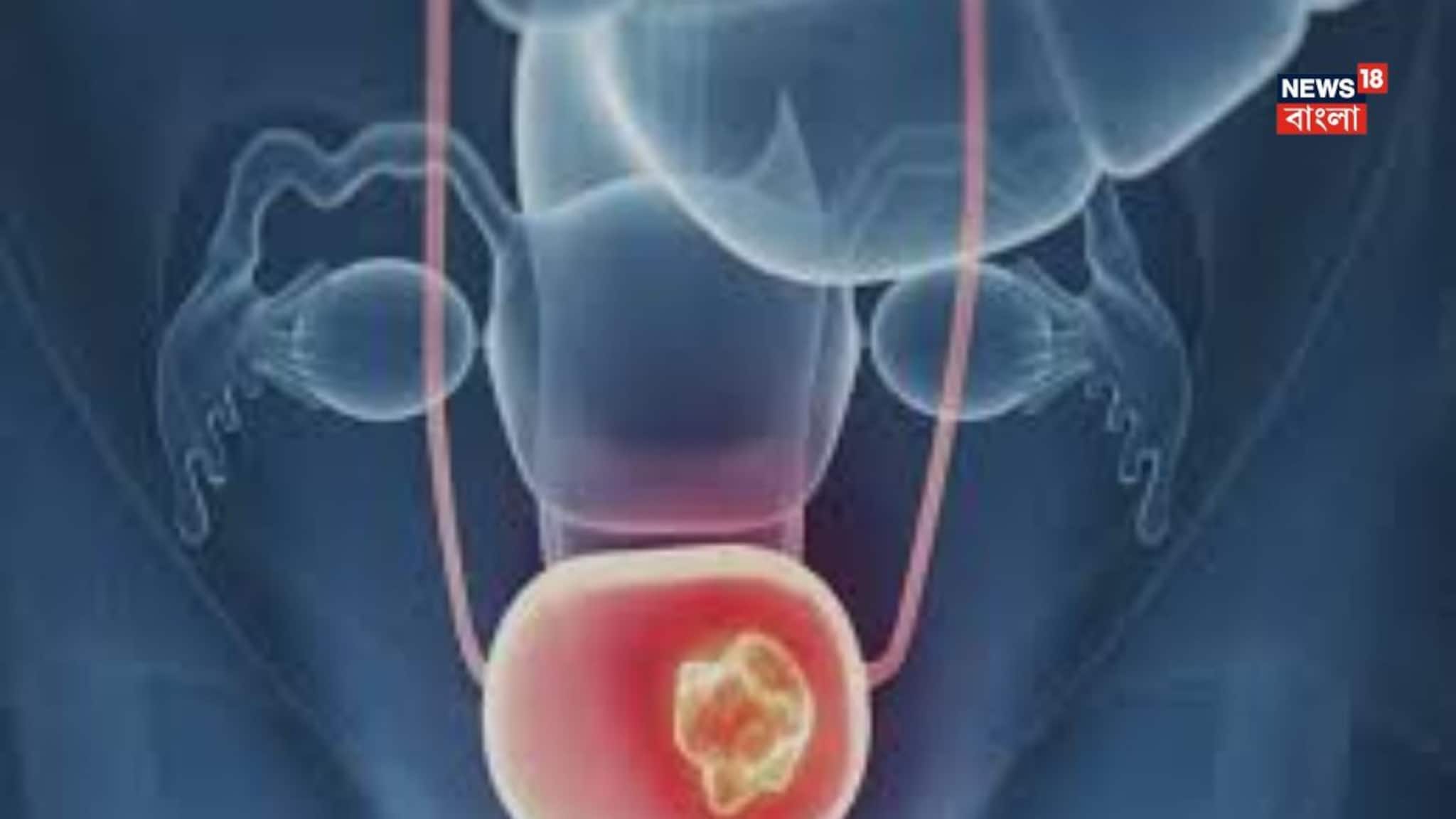 মূত্রাশয় ক্যানসারের ৮০ শতাংশ রোগী ধূমপায়ী? আর কী কী কারণ? চমকে যাবেন, সচেতন হন এখনই...