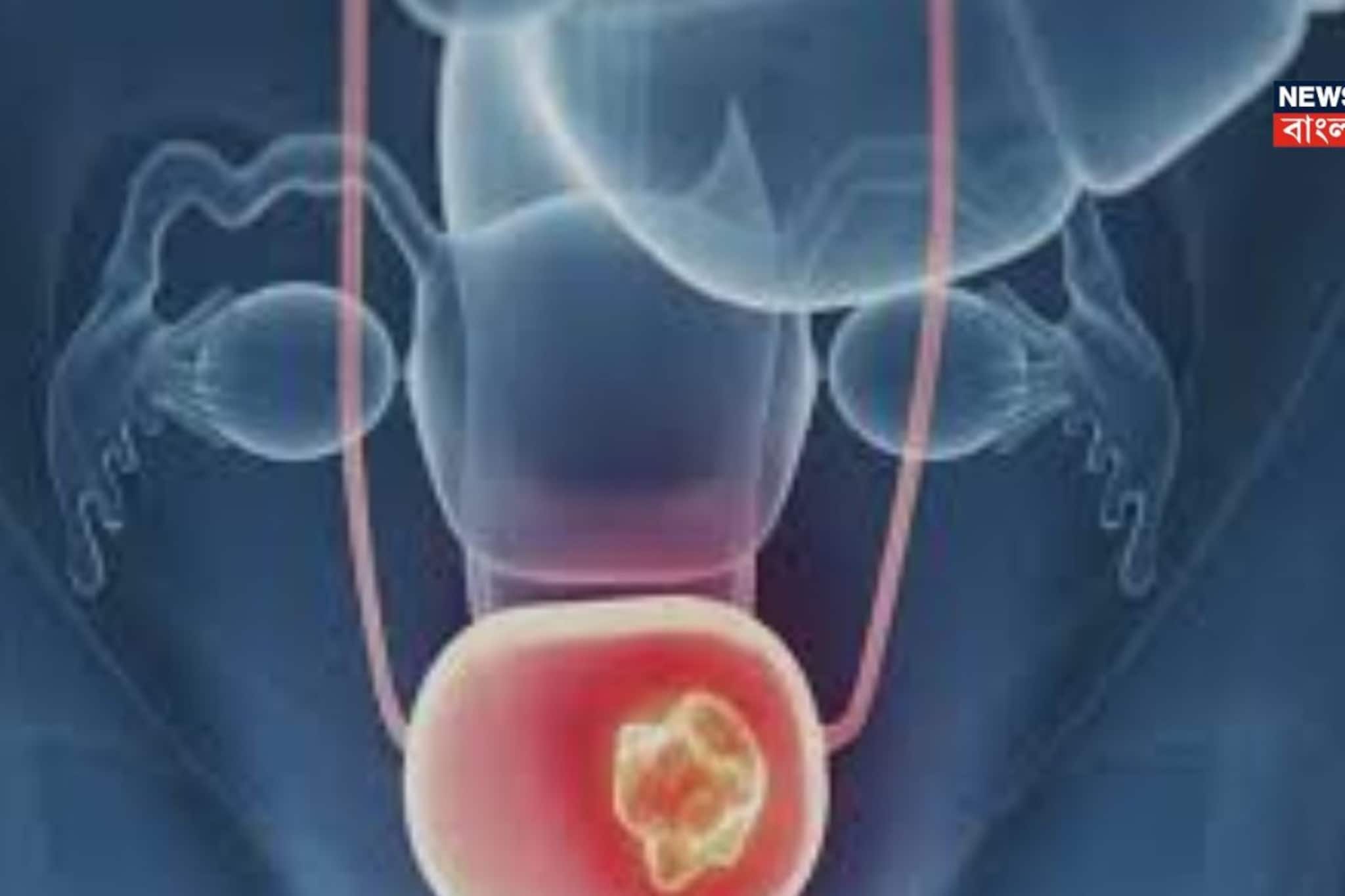 মূত্রাশয় ক্যানসারের ৮০ শতাংশ রোগী ধূমপায়ী? আর কী কী কারণ? চমকে যাবেন, সচেতন হন এখনই