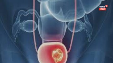 মূত্রাশয় ক্যানসারের ৮০ শতাংশ রোগী ধূমপায়ী? আর কী কী কারণ? চমকে যাবেন, সচেতন হন এখনই