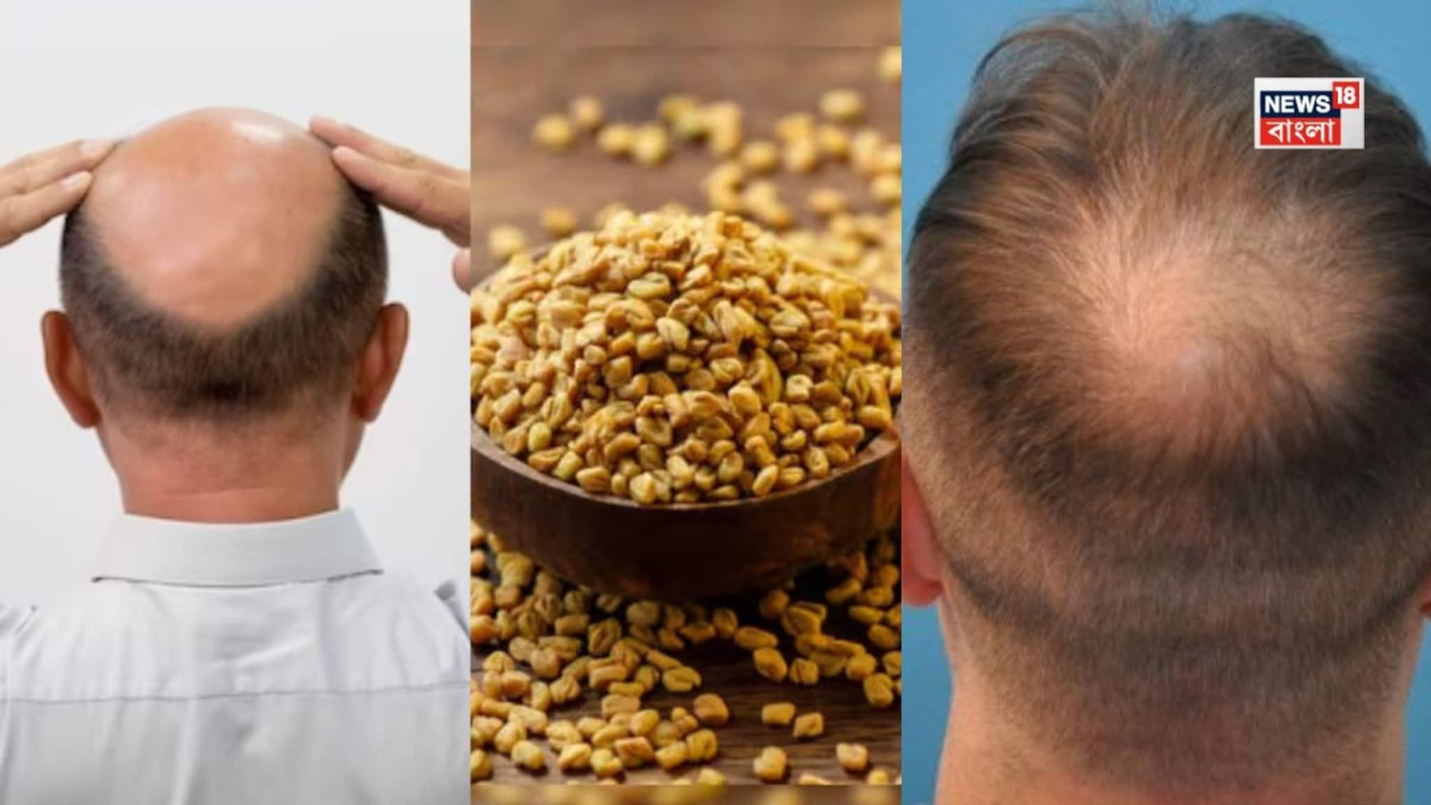 টাক মাথায় চুল গজাবে হুড়হুড়িয়ে... রান্নাঘরে থাকা এই ছোট্ট হলুদ দানা দিয়েই চুল গজাবে হুড়হুড় করে