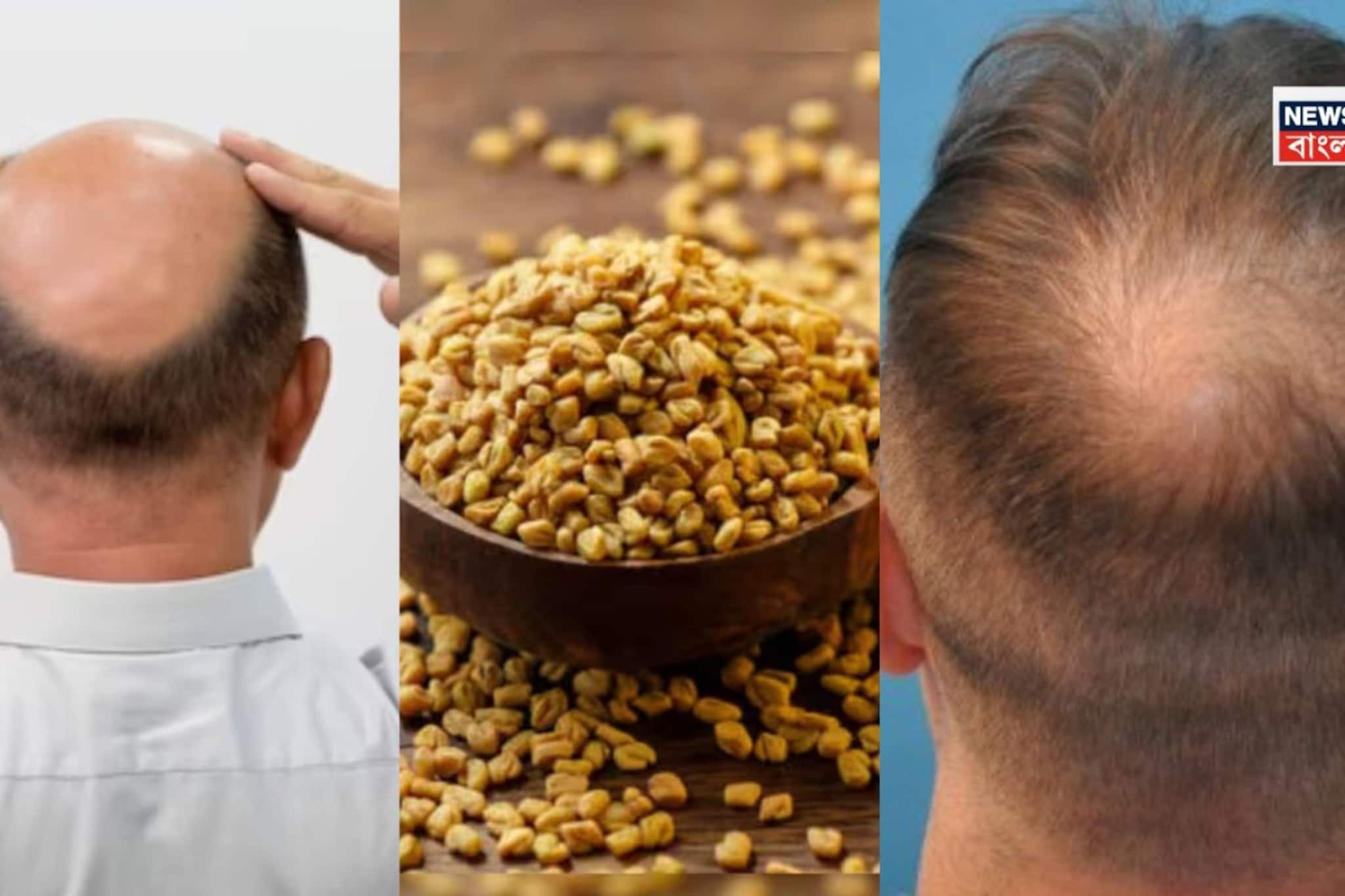 টাক মাথায় চুল গজাবে হুড়হুড়িয়ে... রান্নাঘরে থাকা এই ছোট্ট হলুদ দানা দিয়েই চুল গজাবে