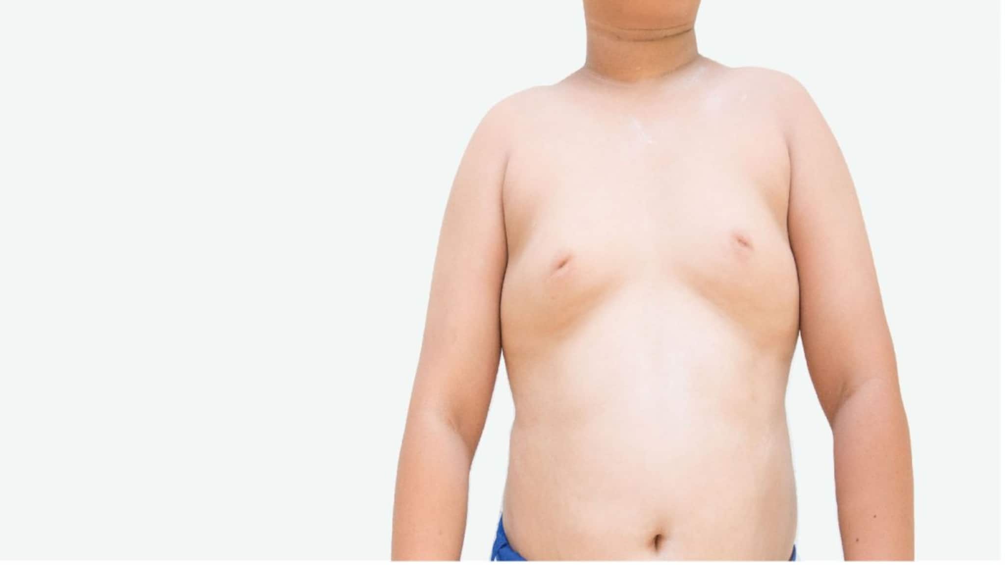 Gynecomastia: অনেক পুরুষই বড় স্তনের কারণে অস্বস্তিতে ভোগেন, অবসাদ নয়, জেনে নিন 'গাইনেকোমাস্টিয়া' কী, কীভাবে এই সমস্যা মেটাবেন