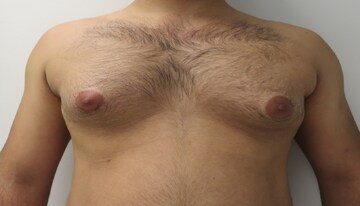 অনেক পুরুষই বড় স্তনের কারণে অস্বস্তিতে ভোগেন, অবসাদ নয়, জেনে নিন 'গাইনেকোমাস্টিয়া' কী