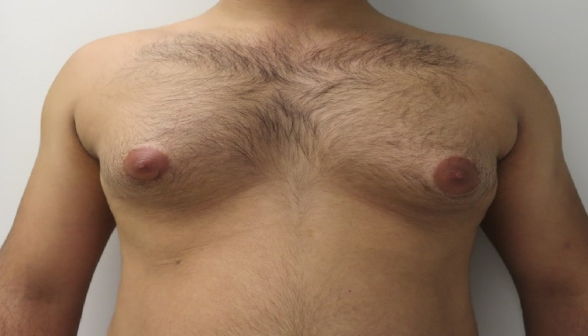 বহু পুরুষের মধ্যেই স্তন বড় হয়ে যাওয়ার প্রবণতা থাকে। ৮-১০ বছরের শিশুদের স্তন সাধারণ এখতু বড় হয়। কিন্তু সাধারণত ১৬-১৭ বছর বয়সে সেই সমস্যা চলে যায়। কিন্তু যদি দেখেন, বয়স বেড়ে গেলেও স্তন স্বাভাবিক হচ্ছে না, তখনই তাকে চিকিৎসা বিজ্ঞানের ভাষায় বলে গাইনেকোমাস্টিয়া। বহু পুরুষের মধ্যেই স্তন বড় হয়ে যাওয়ার প্রবণতা থাকে। ৮-১০ বছরের শিশুদের স্তন সাধারণ এখতু বড় হয়। কিন্তু সাধারণত ১৬-১৭ বছর বয়সে সেই সমস্যা চলে যায়। কিন্তু যদি দেখেন, বয়স বেড়ে গেলেও স্তন স্বাভাবিক হচ্ছে না, তখনই তাকে চিকিৎসা বিজ্ঞানের ভাষায় বলে গাইনেকোমাস্টিয়া।