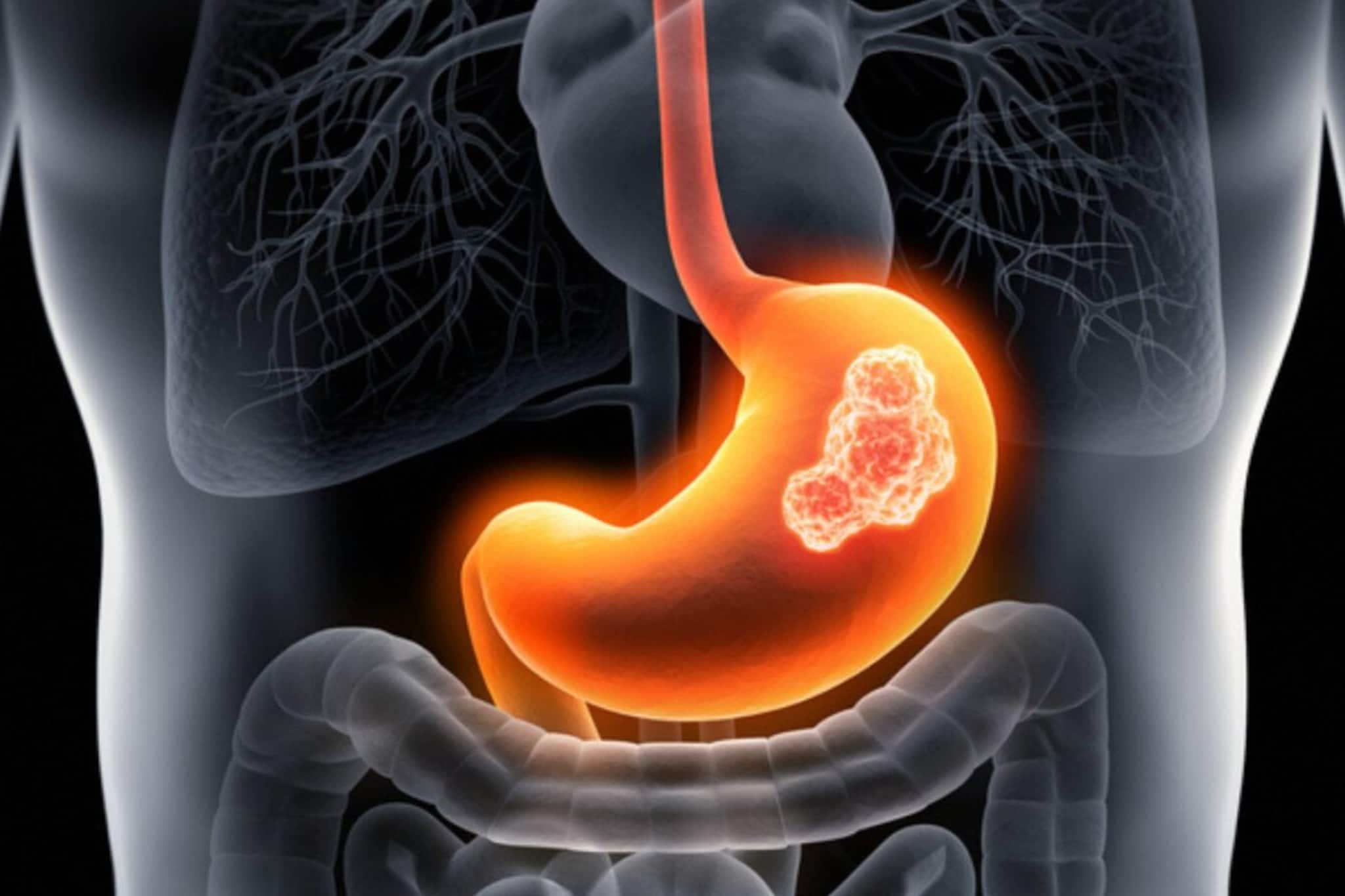 পেটের উপরের দিকে ব্যথা-অস্বস্তি? অবহেলা নয়! গ্যাস্ট্রিক ক্যানসারের যে ৯ উপসর্গ কেউ খেয়ালই করেন না