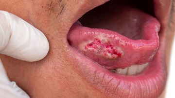 মুখে 'এই' পরিবর্তন দেখলে সাবধান! মারণ কোলন ক্যানসারের লক্ষণ হতে পারে, আজই ডাক্তার দেখান