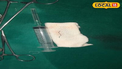 অস্ত্রোপচার করে রোগীর গলা থেকে বের করা হয়েছে তার