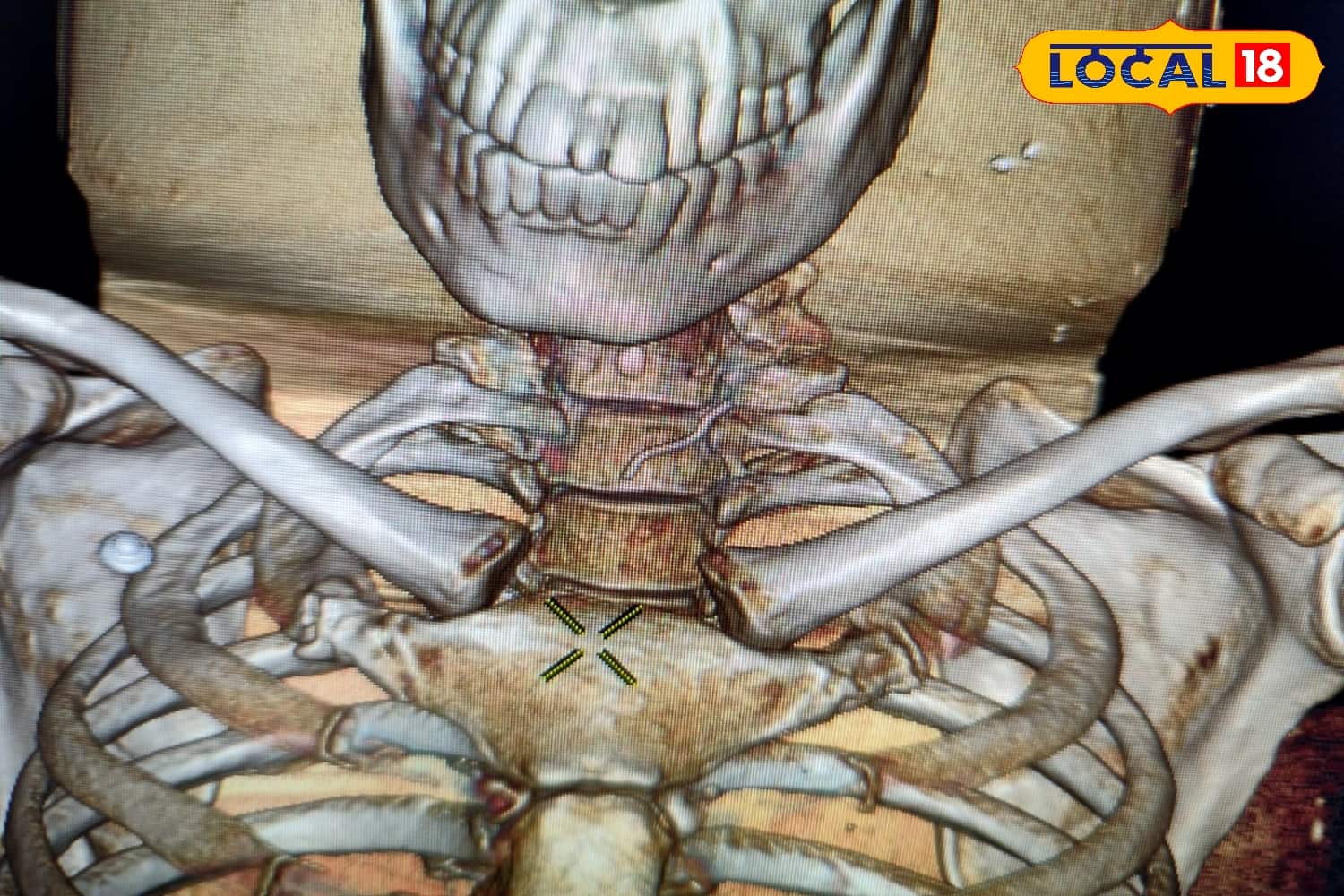 রোগীর গলায় আটকে তার