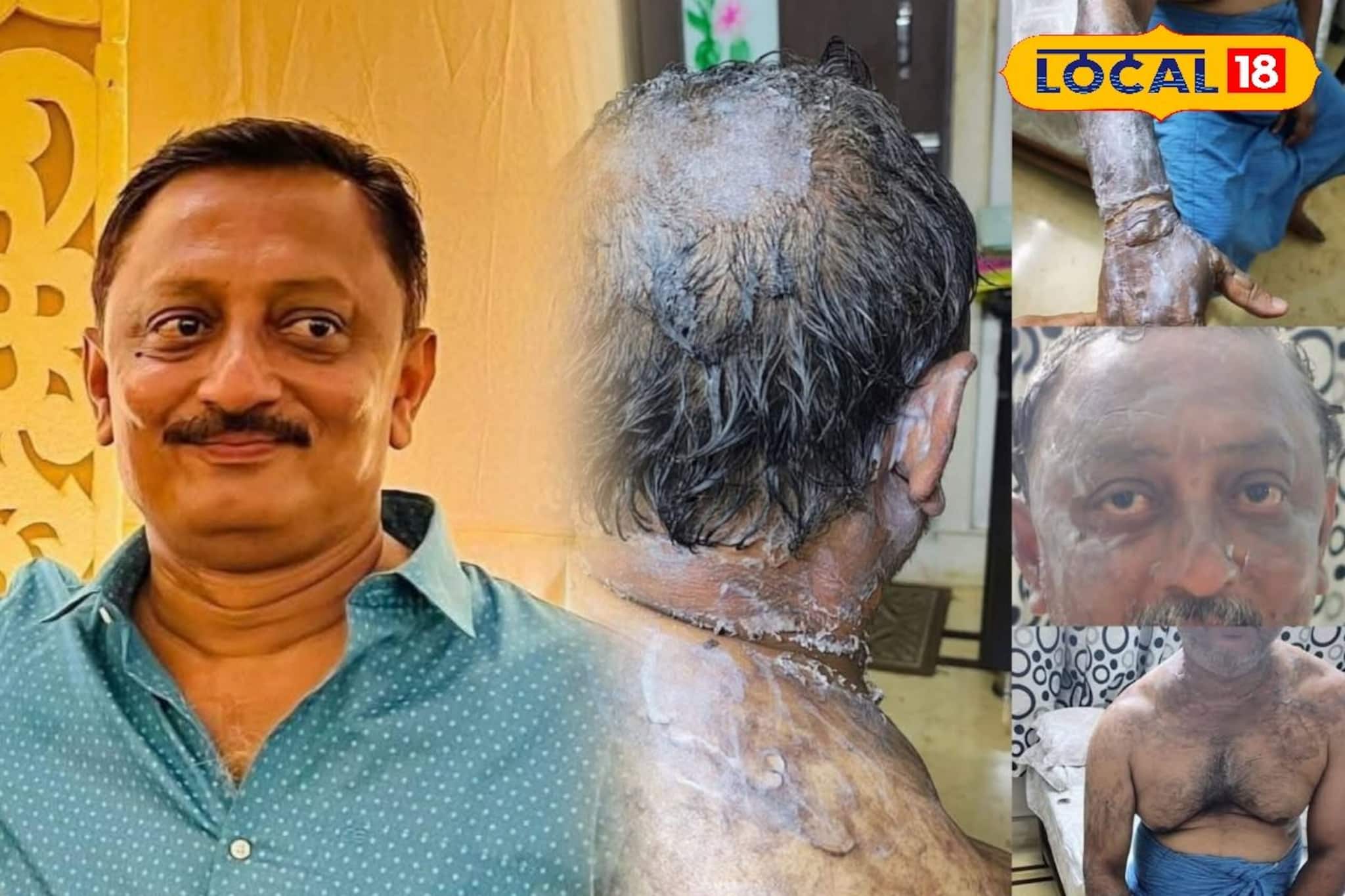 মধ্যমগ্রামে ভয়াবহ আগুন, অনেককে বাঁচিয়ে নিজেই বার্নওয়ার্ডে লড়ছেন 'হিরো' প্রীতম!