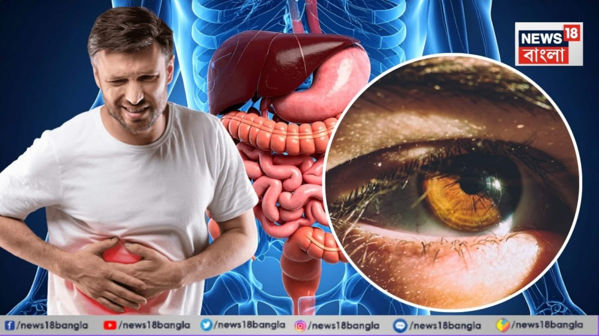 Liver Disease Symptoms: যদি চোখে 'এই' লক্ষণ দেখেন, এটা কিন্তু লিভার ক্যানসারও হতে পারে! আজই চিকিৎসকের কাছে যান