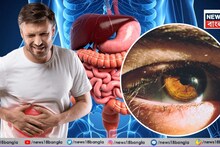 Liver Disease Symptoms: যদি চোখে 'এই' লক্ষণ দেখেন, এটা কিন্তু লিভার ক্যানসারও হতে পারে! আজই চিকিৎসকের কাছে যান
