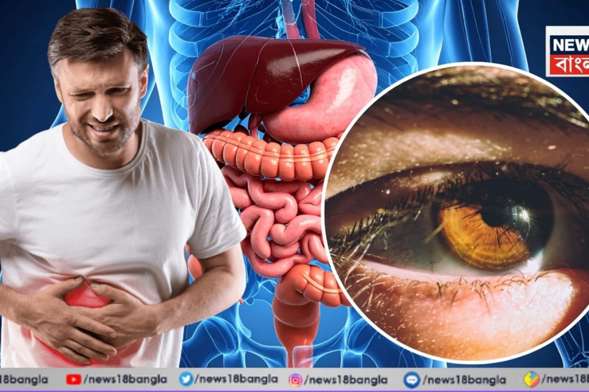 যদি চোখে 'এই' লক্ষণ দেখেন, এটা কিন্তু লিভার ক্যানসারও হতে পারে! আজই চিকিৎসকের কাছে যান