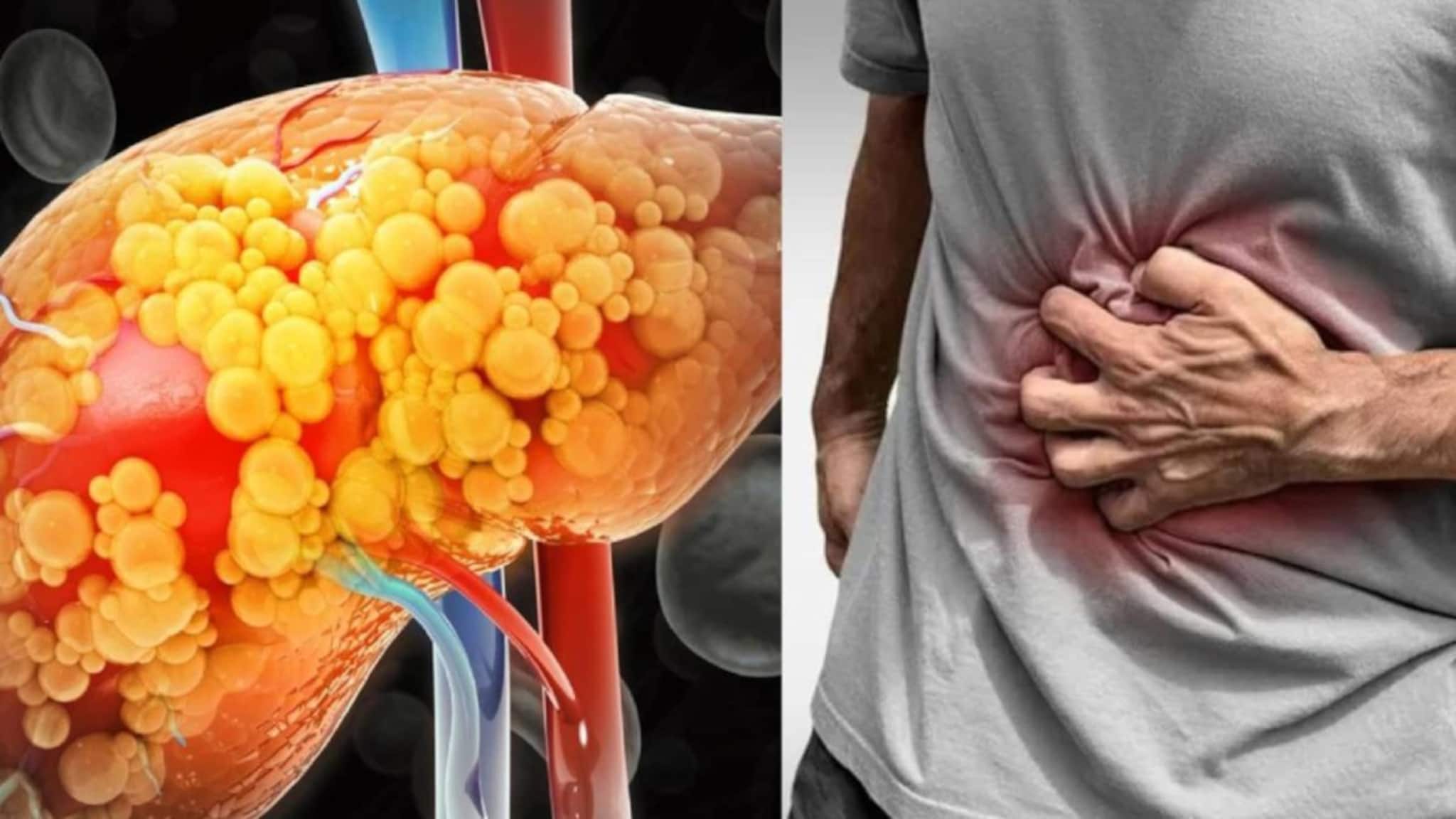 Food to Cause Liver Cirrhosis: এই ৭ খাবারে পচবে লিভার! চিনুন আপনার শরীরের শত্রুদের! আজই বাদ দিন! ঝাঁঝরা হয়ে যাওয়ার হাত থেকে বাঁচুন!