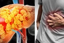 Food to Cause Liver Cirrhosis: এই ৭ খাবারে পচবে লিভার! চিনুন আপনার শরীরের শত্রুদের! আজই বাদ দিন! ঝাঁঝরা হয়ে যাওয়ার হাত থেকে বাঁচুন!