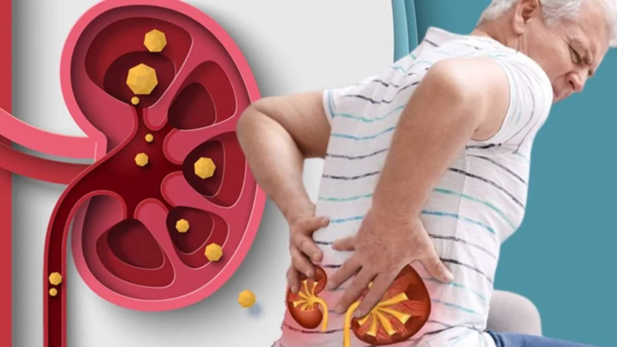 Food to cause Kidney Stone: পালং শাক, রেডমিট...আর কোন কোন খাবার খেলে কিডনিতে জমবে পাথর? কী খেলে গলবে? মুখে দেওয়ার আগে জানুন