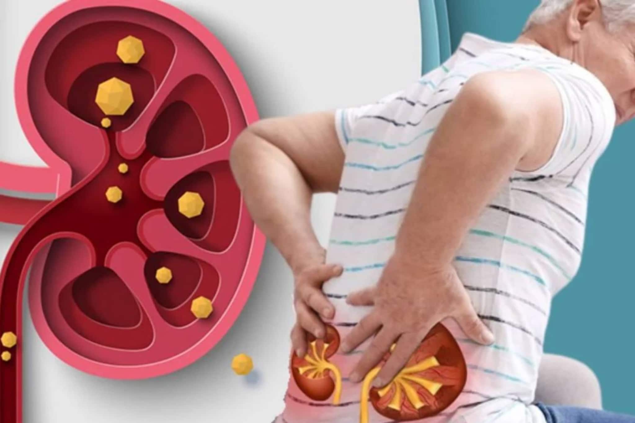 পালং শাক, রেডমিট...আর কোন কোন খাবার খেলে কিডনিতে জমবে পাথর? কী খেলে গলবে? মুখে দেওয়ার আগে জানুন পালং শাক, রেডমিট...আর কোন কোন খাবার খেলে কিডনিতে জমবে পাথর? কী খেলে গলবে? মুখে দেওয়ার আগে জানুন