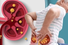 Food to cause Kidney Stone: পালং শাক, রেডমিট...আর কোন কোন খাবার খেলে কিডনিতে জমবে পাথর? কী খেলে গলবে? মুখে দেওয়ার আগে জানুন
