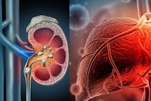 Kidney Stone & Fatty Liver: চুমুকে সর্বনাশ! এই চা খেলে কিডনিতে হতে পারে পাথর! মেদ জমে পচতে পারে লিভার! আরও ভয়ঙ্কর রোগ থেকে সাবধান!