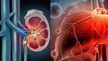 চুমুকে সর্বনাশ! এই চা খেলে কিডনিতে হতে পারে পাথর! পচতে পারে লিভার! ভয়ঙ্কর রোগ থেকে সাবধান