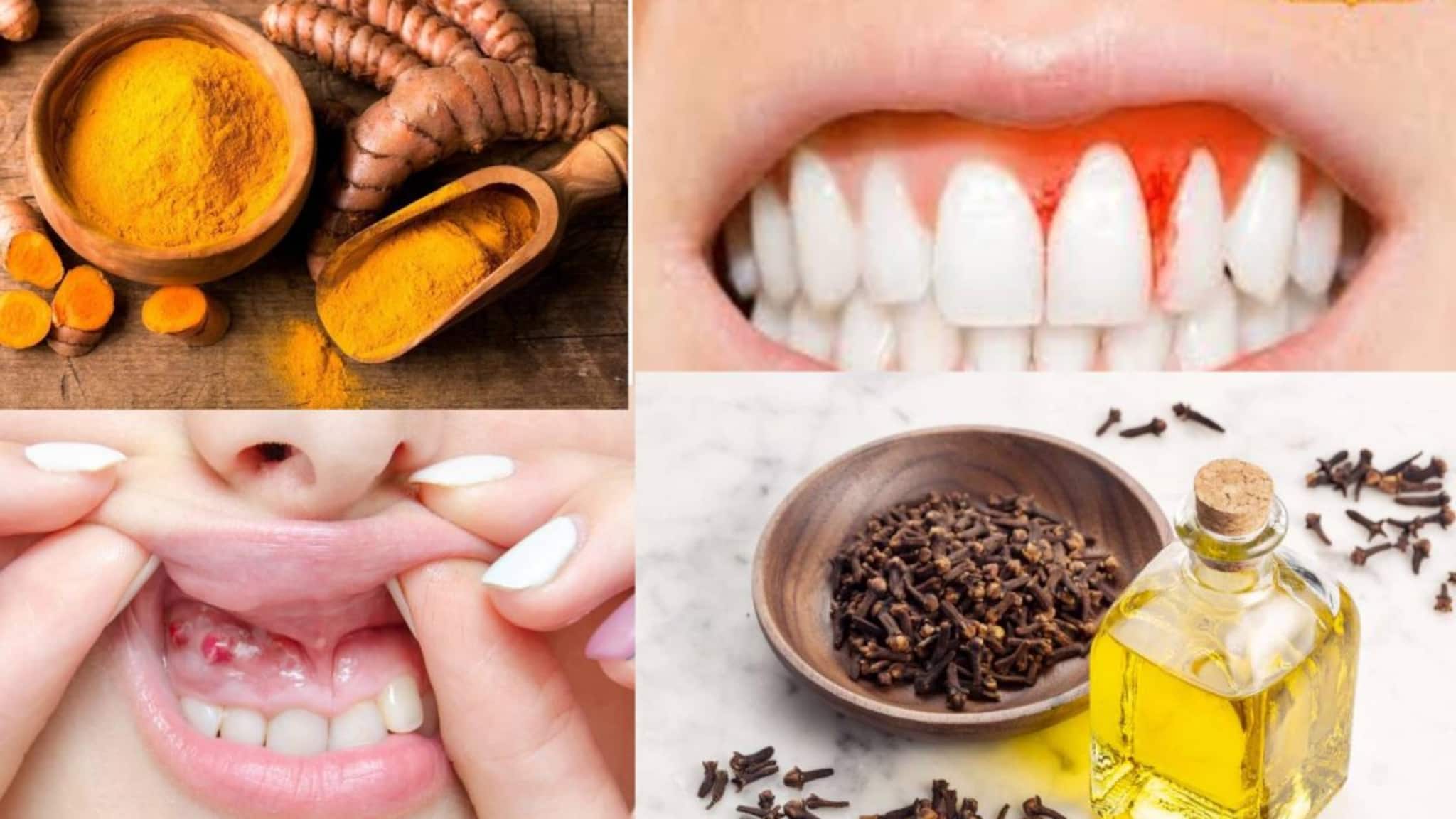 Pyorrhea Home Remedies: দাঁত ব্রাশ করার সময় মাড়ি থেকে গলগলিয়ে রক্ত? ১ চিমটে হলুদের কামালে নির্বংশ পায়োরিয়া