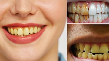 রোজ ২ বার মেজেও দাঁতে হলুদ ছোপ? দায়ী এই ‘৪’ কারণ! এখনই জানুন এবং সতর্ক হোন রোজ ২ বার মেজেও দাঁতে হলুদ ছোপ? দায়ী এই ‘৪’ কারণ! এখনই জানুন এবং সতর্ক হোন
