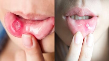 মিছরির সঙ্গে জাস্ট কয়েকটা এই ‘দানা’...মিশিয়ে লাগালে দগদগে মাউথ আলসারের জ্বালা গায়েব নিমেষে