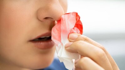 उन्हाळ्यात नाकातून रक्तस्राव? ही एक चूक टाळा! रक्त घशात जाऊ शकते