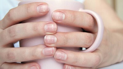 অনেক সময়, আমরা আমাদের নখে ছোট ছোট সাদা দাগ লক্ষ্য করি এবং সাথে সাথেই ভাবি যে আমাদের কি কোনও গুরুতর ঘাটতি আছে। কেউ কেউ এটিকে ক্যালসিয়ামের ঘাটতির জন্য দায়ী করেন, আবার কেউ কেউ এটিকে কোনও শারীরিক অবস্থার লক্ষণ বলে মনে করেন। সত্য কথা হল, নখে এই সাদা দাগের অনেক সম্ভাব্য কারণ থাকতে পারে। এগুলি উপেক্ষা করার আগে সঠিক তথ্য থাকা গুরুত্বপূর্ণ।