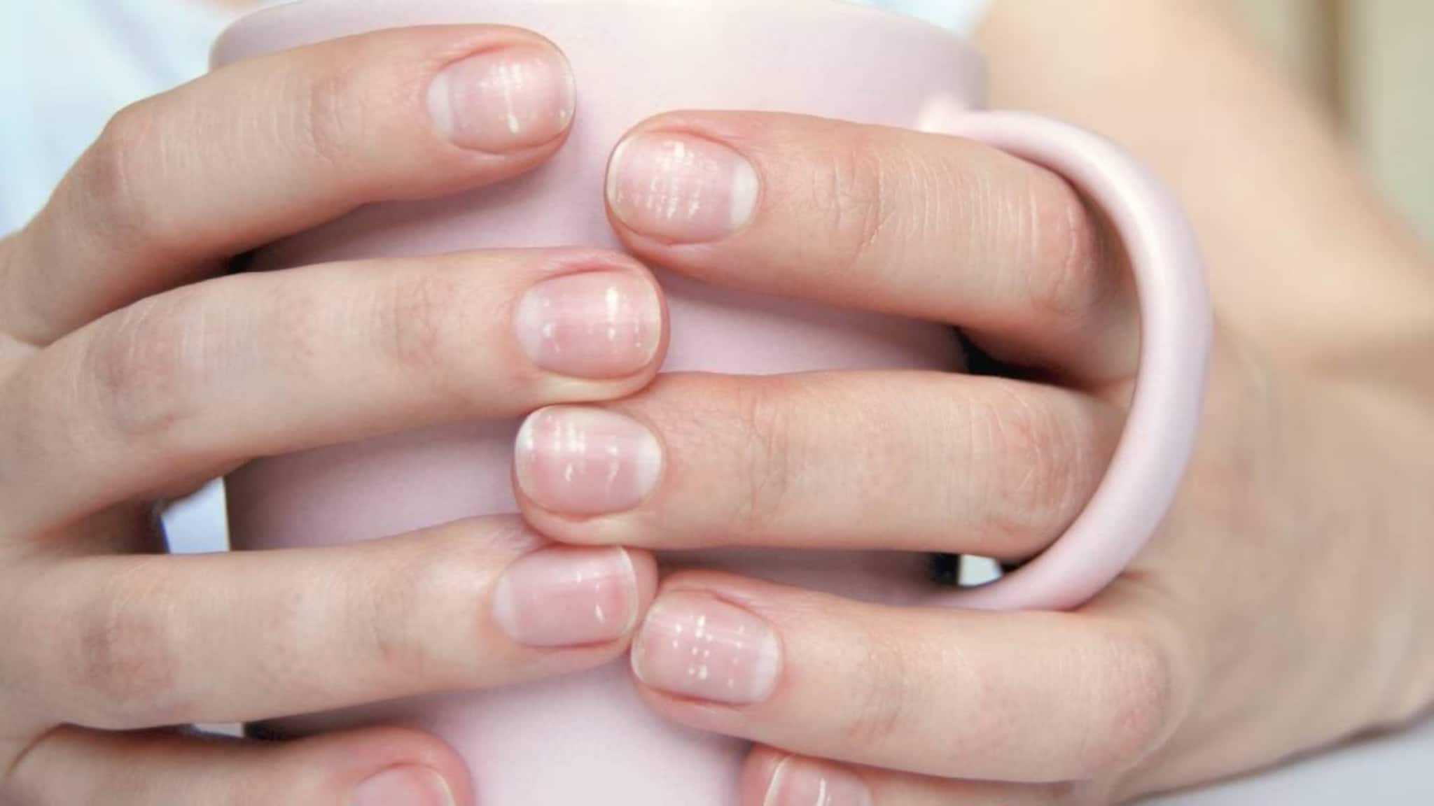 White Spots on Nails: আপনার নখে কি সাদা দাগ আছে? কোন বড় রোগের লক্ষণ? জটিল অসুখ বাসা বেধেছে শরীরে? জানুন