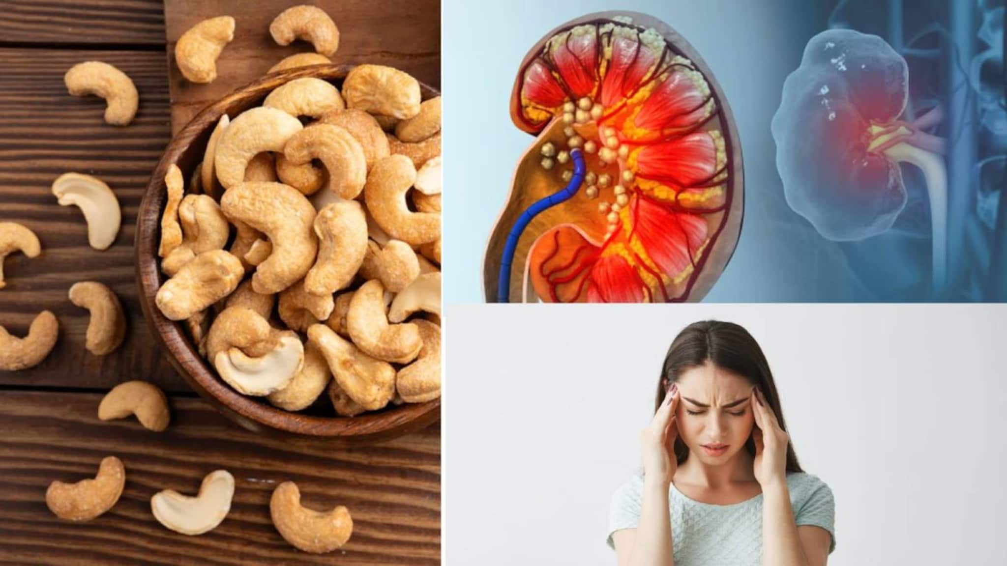 Cashewnut Side Effects: কিডনিতে পাথর, মাইগ্রেন...আর কোন কোন রোগে কাজুবাদাম বিপজ্জনক? জানুন কারা ভুলেও এটা দাঁতে কাটবেন না