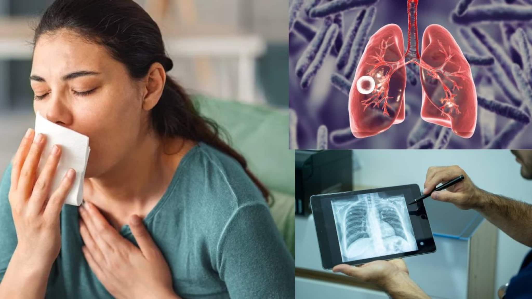 TB Symptoms: সাধারণ উপসর্গেই লুকিয়ে রাজরোগ যক্ষ্মা! এখনই চিনে নিন লক্ষণগুলি, বাঁচুন ভয়ঙ্কর ছোঁয়াচে অসুখের থাবা থেকে