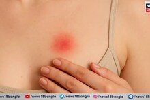 Breast Cancer: স্তন-স্তনবৃন্ত বা বগলের আশপাশে কোনও দাগ বা ফুসকুড়ি স্তন ক্যানসারের প্রাথমিক লক্ষণ? আয়নার সামনে দাঁড়িয়ে পরীক্ষা করুন ভাল করে