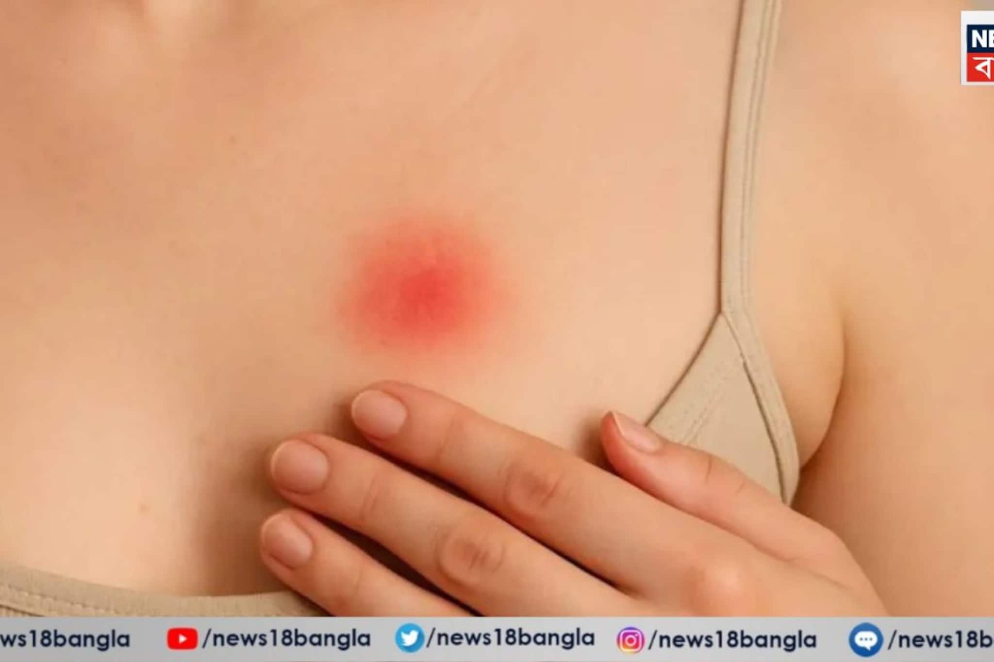 স্তন-স্তনবৃন্ত বা বগলের আশপাশে কোনও দাগ বা ফুসকুড়ি স্তন ক্যানসারের প্রাথমিক লক্ষণ?