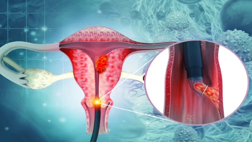 ক্যানসার যে কাউকে এবং যে কোনও বয়সে আক্রমণ করতে পারে। বেশিরভাগ ক্যানসারের নির্দিষ্ট কারণ চিহ্নিত করা কঠিন হলেও, এমন কিছু ক্যানসার রয়েছে যেগুলি থেকে মানুষ সচেতনভাবে নিজেকে সুরক্ষিত রাখতে পারেন। মহিলাদের ক্ষেত্রে সার্ভাইক্যাল ক্যানসার বা জরায়ুমুখের ক্যানসার তেমনই একটি রোগ। ক্যানসার যে কাউকে এবং যে কোনও বয়সে আক্রমণ করতে পারে। বেশিরভাগ ক্যানসারের নির্দিষ্ট কারণ চিহ্নিত করা কঠিন হলেও, এমন কিছু ক্যানসার রয়েছে যেগুলি থেকে মানুষ সচেতনভাবে নিজেকে সুরক্ষিত রাখতে পারেন। মহিলাদের ক্ষেত্রে সার্ভাইক্যাল ক্যানসার বা জরায়ুমুখের ক্যানসার তেমনই একটি রোগ।