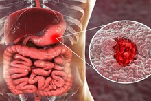 Peptic Ulcer: ঘন ঘন পেট ব্যথাই হতে পারে 'আলসার'-এর সিগন্যাল, এর থেকে হতে পারে ক্যানসারও, কোন ৪ খাবার আলসারের যম? পড়ুন