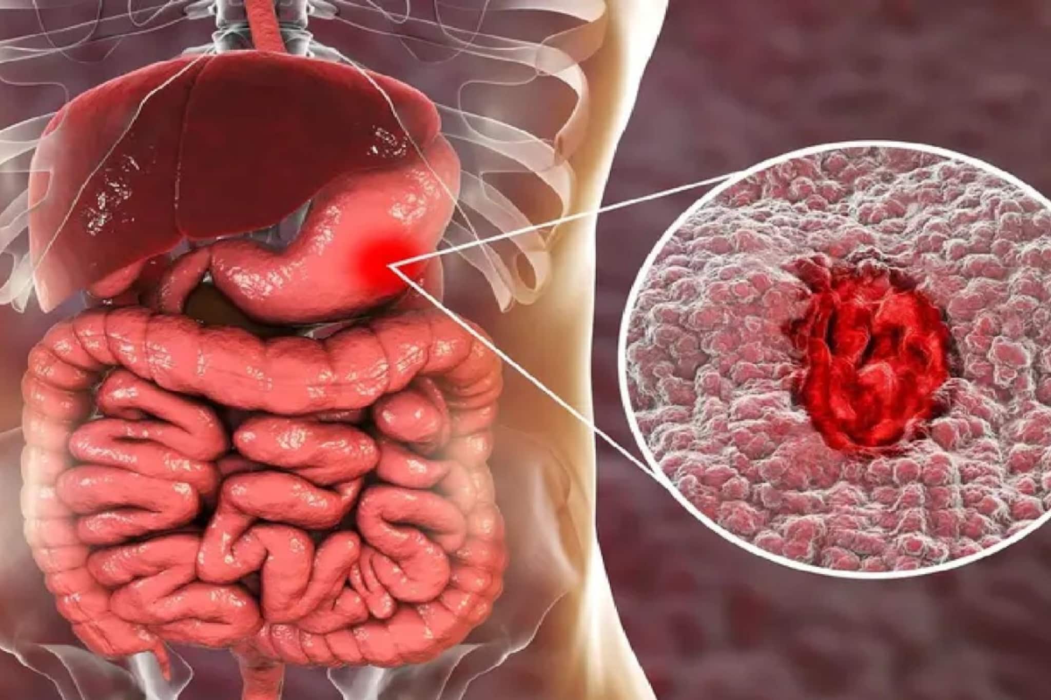  ঘন ঘন পেট ব্যথাই হতে পারে 'আলসার'-এর সিগন্যাল, এর থেকে হতে পারে ক্যানসারও, কোন ৪ খাবার আলসারের যম? পড়ুন