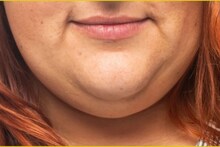 Double Chin: থুতনির নিচের বিরক্তিকর 'ডবল চিন'! অতিরিক্ত চর্বি বাড়িয়ে দেয় চেহারার বয়স! শুধু ১ মিনিটের টোটকায় কমবে ম্যাজিকের মতো