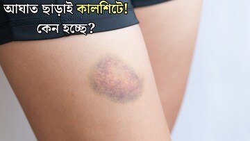 কোনও আঘাত ছাড়াই শরীরের যেখানে সেখানে পড়ছে কালশিটে? কোন ভিটামিনের অভাবে এমন নীলচে দাগ হয় জানেন?