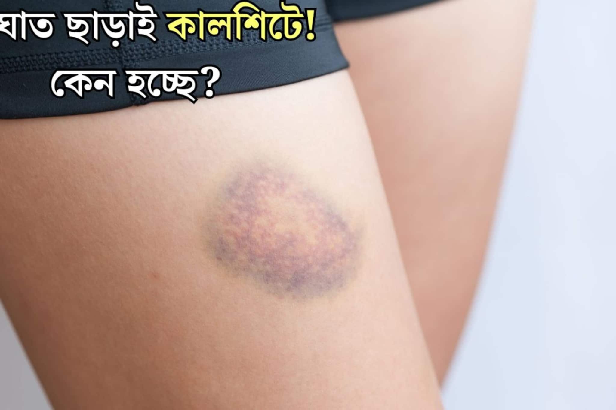 কোনও আঘাত ছাড়াই শরীরের যেখানে সেখানে পড়ছে কালশিটে? কোন ভিটামিনের অভাবে এমন নীলচে দাগ হয় জানেন?
