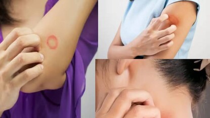 Skin Tan & Sun Burn Remedies: চড়া রোদে ঝলসে গিয়ে ত্বকের দফারফা? দাদ, চুলকানিতে ক্ষতবিক্ষত? নিম-লেবু এভাবে দিলেই সব উধাও