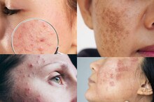 Pimples & other Skin Problems: সুপুরির মতো দেখতে এই মশলার গুঁড়ো ‘এভাবে’ মাখলেই সাফ কালো কুচকুচে মেচেতা! দগদগে ব্রণ মিলিয়ে মসৃণ মুখের ত্বক