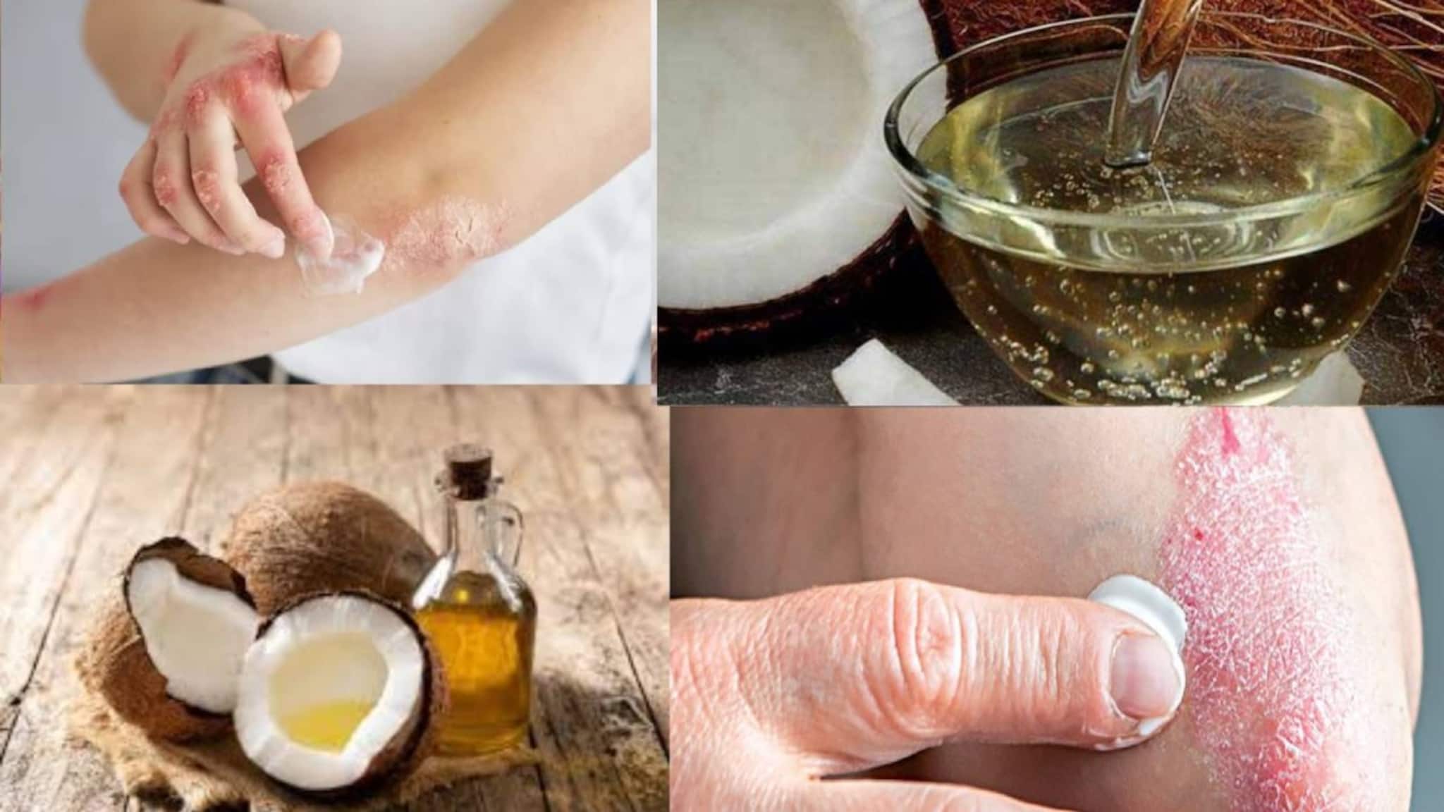 Skin Diseases Home Remedies: ২ তেলে মুক্তি চর্মরোগ থেকে! ঘরোয়া টোটকায় সারবে চামড়ার উপর দগদগে ফুসকুড়ি ও চুলকানি! গায়েব অস্বস্তি